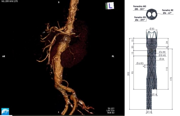 Prótese inédita produzida no país é utilizada para tratar aneurisma de paciente_