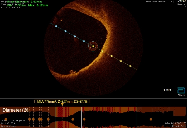 Procedimento inédito no Brasil previne AVC em paciente de 85 anos com aterosclerose_