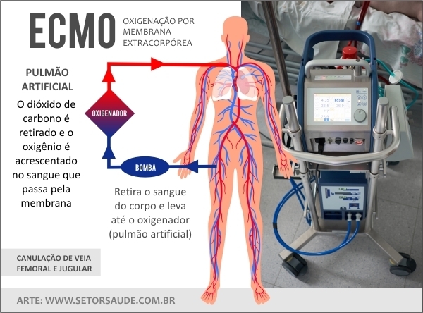 ecmo
