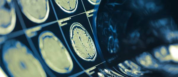 AVC reconhecer os sinais é fundamental para salvar vidas