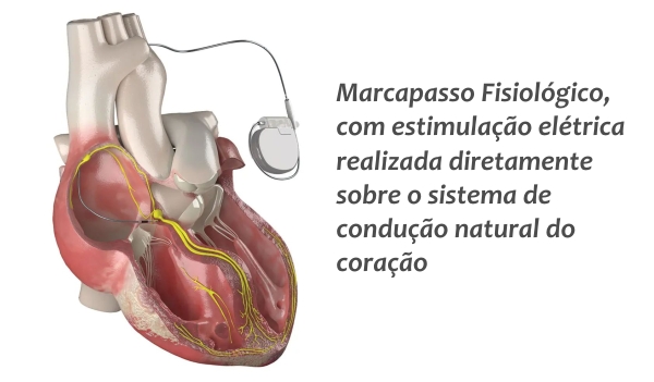 marcapasso fisiologico