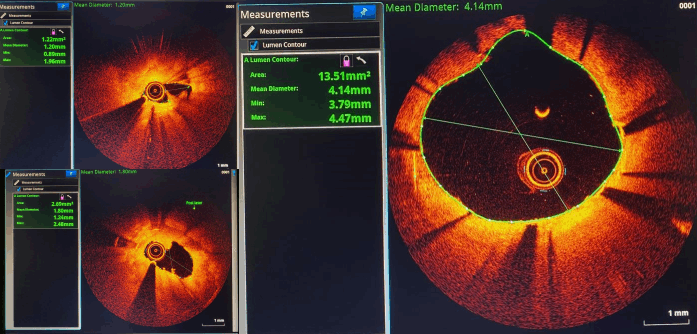 laser desobstruir artérias cardiologia